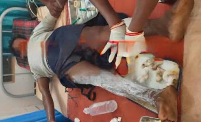 नक्सलियों द्वारा लगाए गए प्रेसर आईईडी विस्फोट में श्रमिक घायल