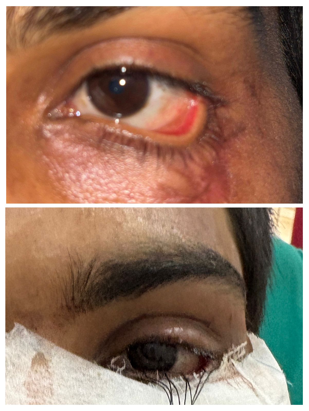 स्किन ग्राफ्टिंग से युवक को नई दृष्टि और सामान्य जीवन की ओर लौटने का मिला अवसर