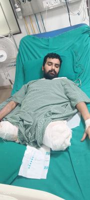  दुर्घटना में कट गये थे दोनों पांव, फिर भी बचा ली जान