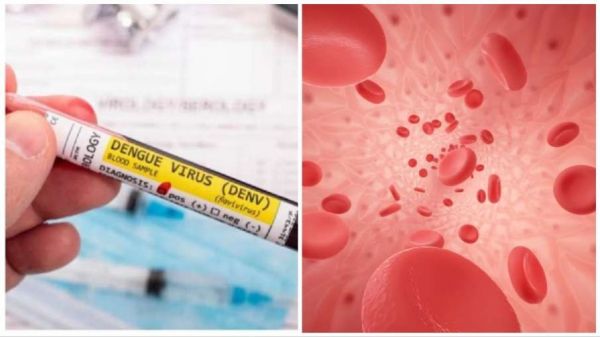 सेहत : डेंगू के मरीज तेजी से प्लेटलेट्स बढ़ाने क्या करें?